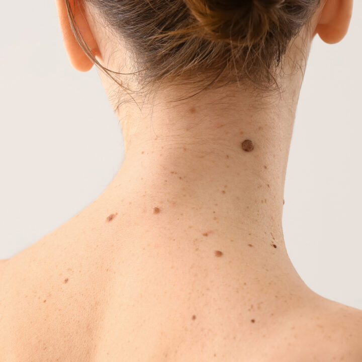 Moedervlek verwijderen
